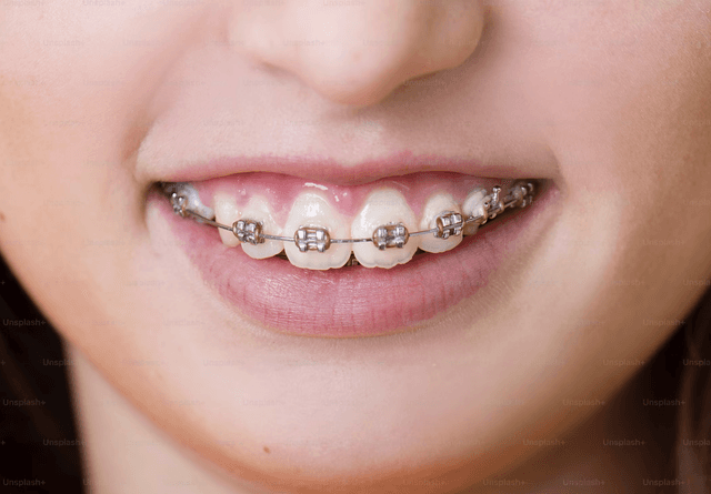 Traditional Braces